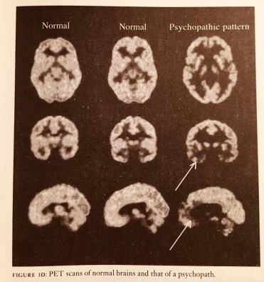 jamesfallons-thepsychopathicinside-Petscans-reddit